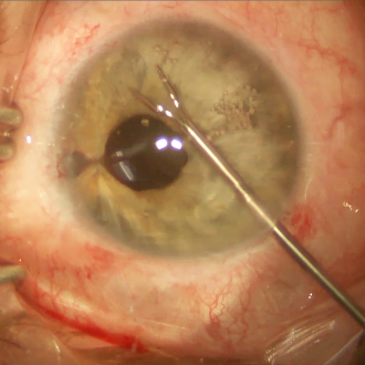 Riveting with double-flanged polypropylene suture helps restore iridodialysis 2