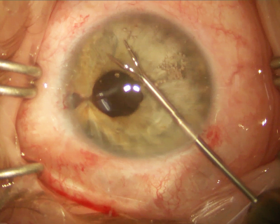 Riveting with double-flanged polypropylene suture helps restore iridodialysis 11